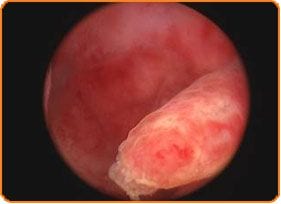 Hysteroskopie - In Vitro Fertilisation - Zentrum IVF Mitosis