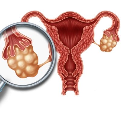 In Vitro Fertilisation Eizellen Spende - Zentrum-IVF-Mitosis-Griechenland