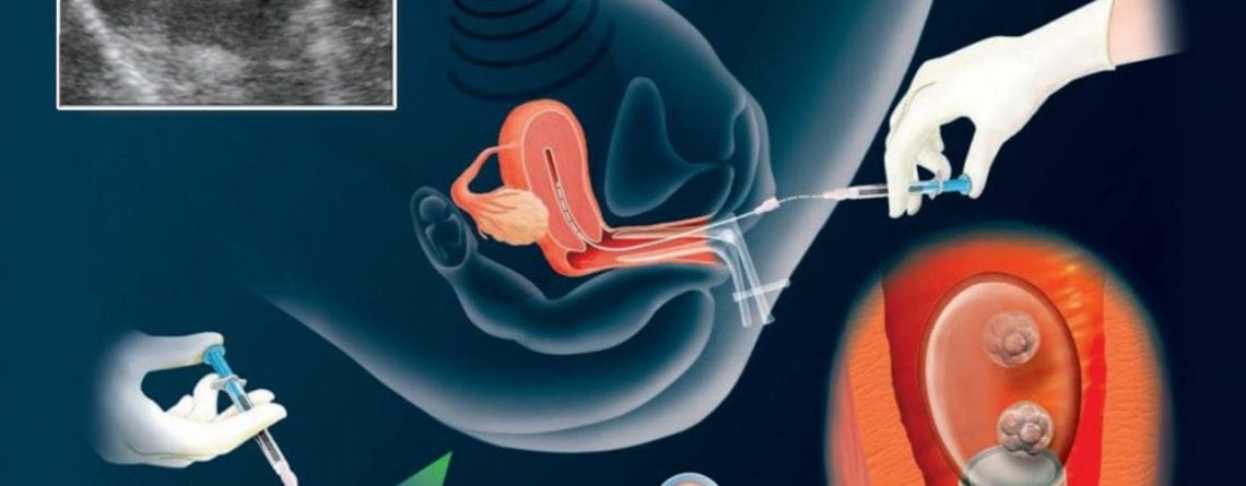 Άρθρο του Δρ. Θεοδόση Αρκουλή για την εμβρυομεταφορά στο familylife.gr