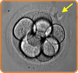 Assisted Hatching - In Vitro Fertilization - Centre FIV Mitosis