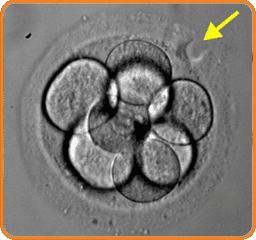 Assisted Hatching (IVF) - In Vitro Fertilization Services Mitosis