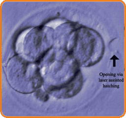Éclosion assistée - Fécondation in vitro - Centre de Fertilité FIV Mitosis