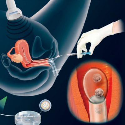 Embryo transfer in Mitosis IVF Clinic