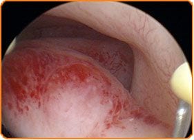 Histeroscopia - Centrul de FIV Mitosis