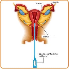 IUI Intrauterine Insemination - IVF Center Greece Mitosis