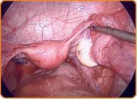 Laparoscopy Diagnostic Invasive - In Vitro Fertilization - Centre FIV Mitosis