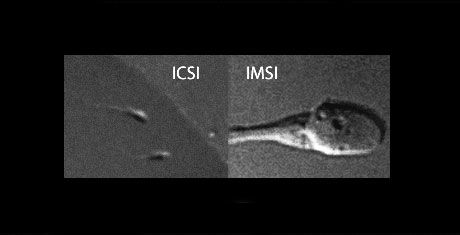 IMSI – New method for choosing the healthiest sperm - In Vitro Fertilization - Centre FIV Mitosis