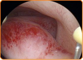 Uteroscopy Diagnostic Invasive - In Vitro Fertilization - Centre FIV Mitosis