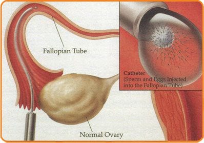 GIFT - Intratubarer Transfer von Gameten, Eizellen und Spermium - Zentrum für In-vitro-Fertilisation „Mitosis“