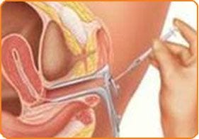 IUI Inseminazione Intrauterina - Centro di Fecondazione in vitro Mitosi