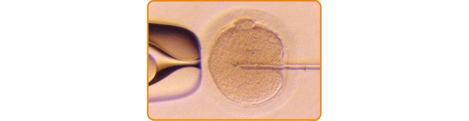 Insemination Intra Cytoplasmique de Spermatozoide - Center FIV Mitosis